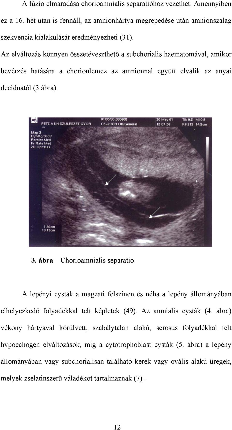 ábra Chorioamnialis separatio A lepényi cysták a magzati felszínen és néha a lepény állományában elhelyezkedő folyadékkal telt képletek (49). Az amnialis cysták (4.