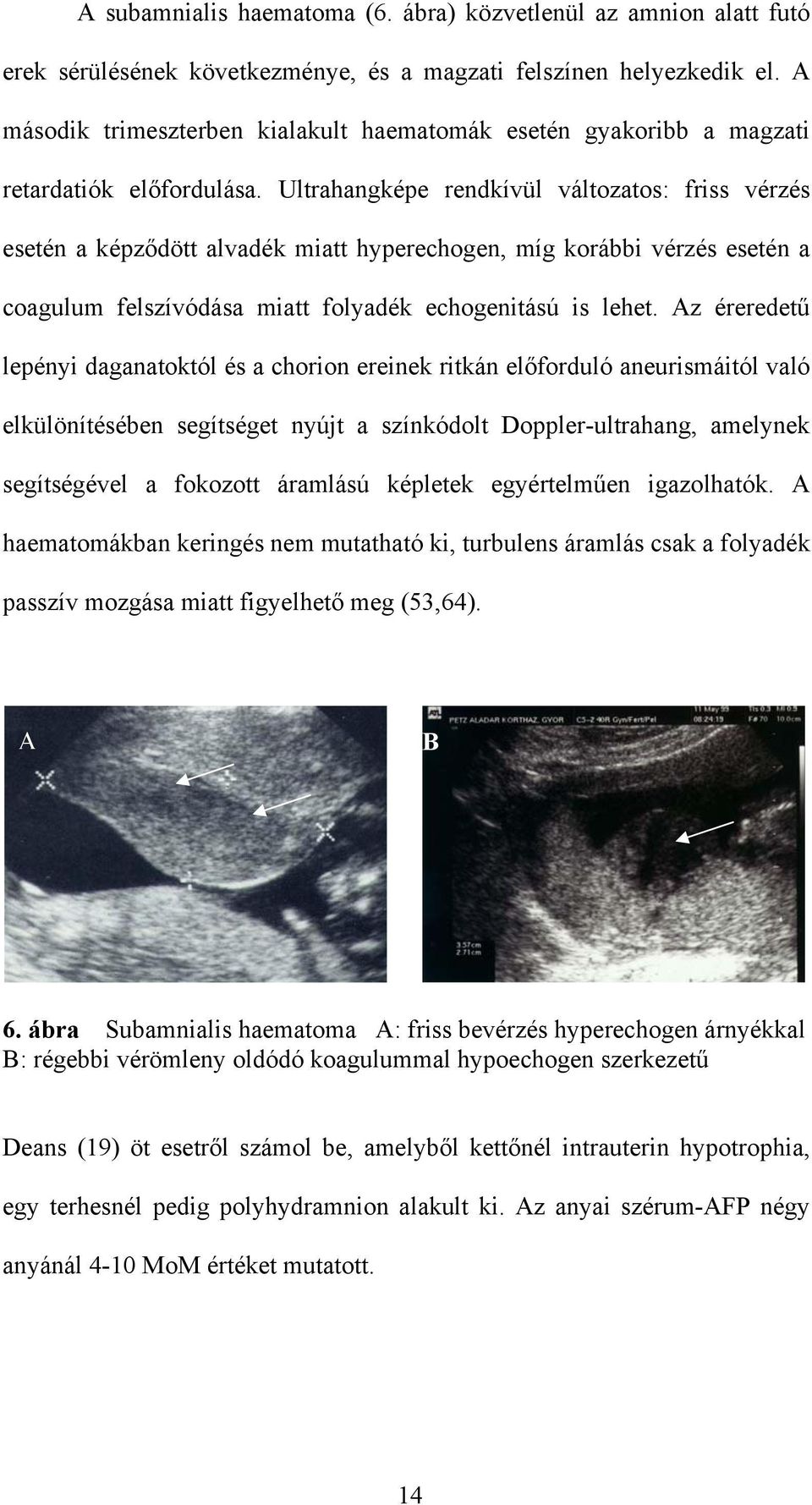 Ultrahangképe rendkívül változatos: friss vérzés esetén a képződött alvadék miatt hyperechogen, míg korábbi vérzés esetén a coagulum felszívódása miatt folyadék echogenitású is lehet.