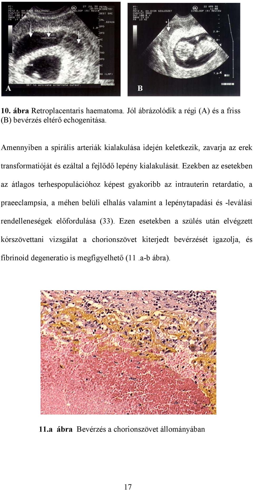 Ezekben az esetekben az átlagos terhespopulációhoz képest gyakoribb az intrauterin retardatio, a praeeclampsia, a méhen belüli elhalás valamint a lepénytapadási és