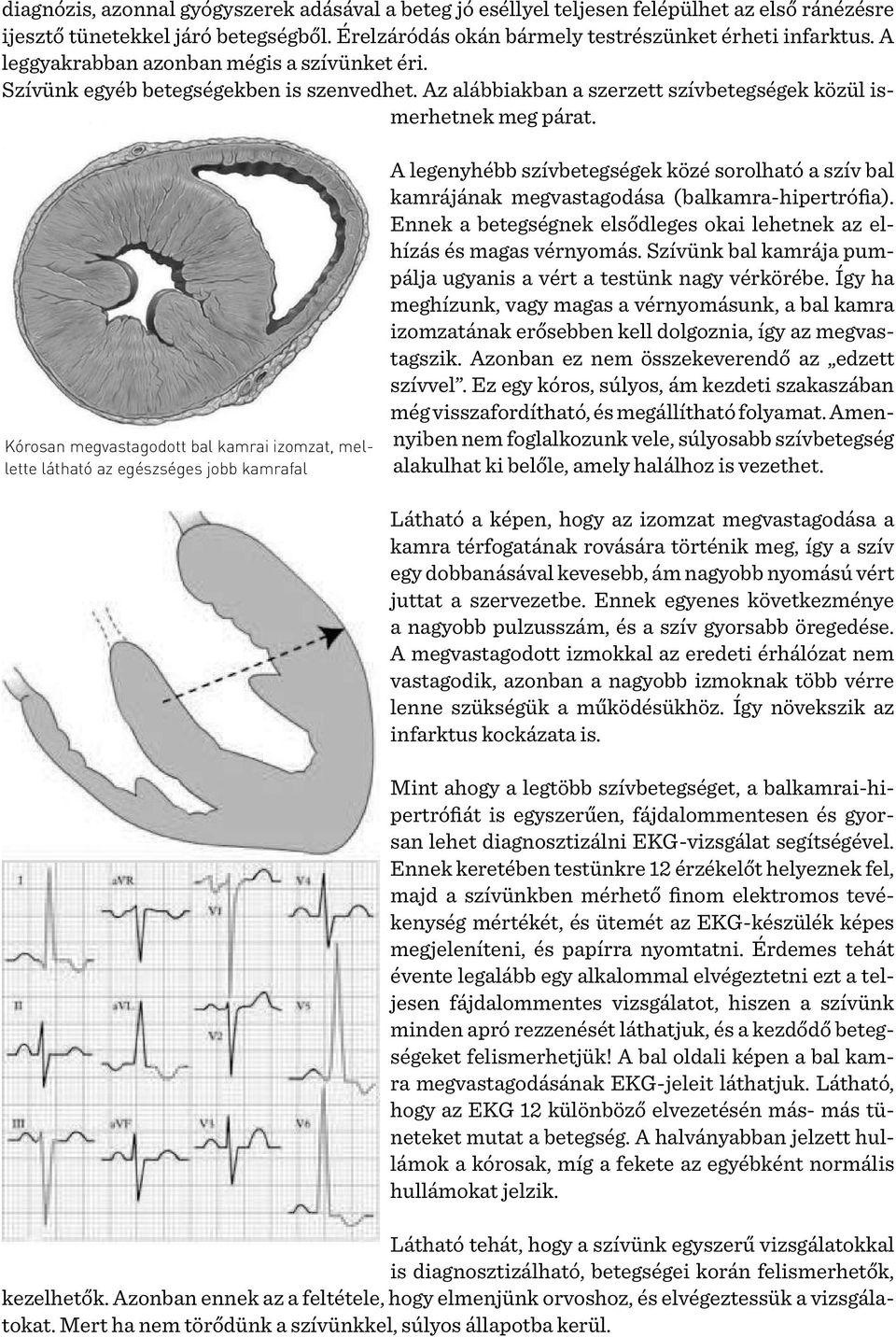 Kórosan megvastagodott bal kamrai izomzat, mellette látható az egészséges jobb kamrafal A legenyhébb szívbetegségek közé sorolható a szív bal kamrájának megvastagodása (balkamra-hipertrófia).