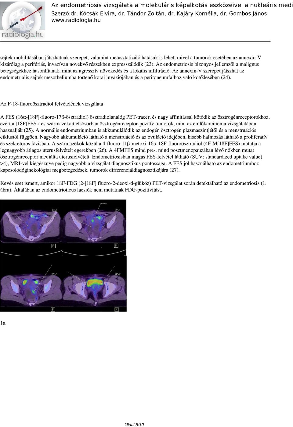 Az annexin-v szerepet játszhat az endometrialis sejtek mesotheliumba történő korai inváziójában és a peritoneumfalhoz való kötődésében (24).