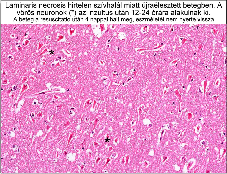A vörös neuronok (*) az inzultus után 12-24 órára