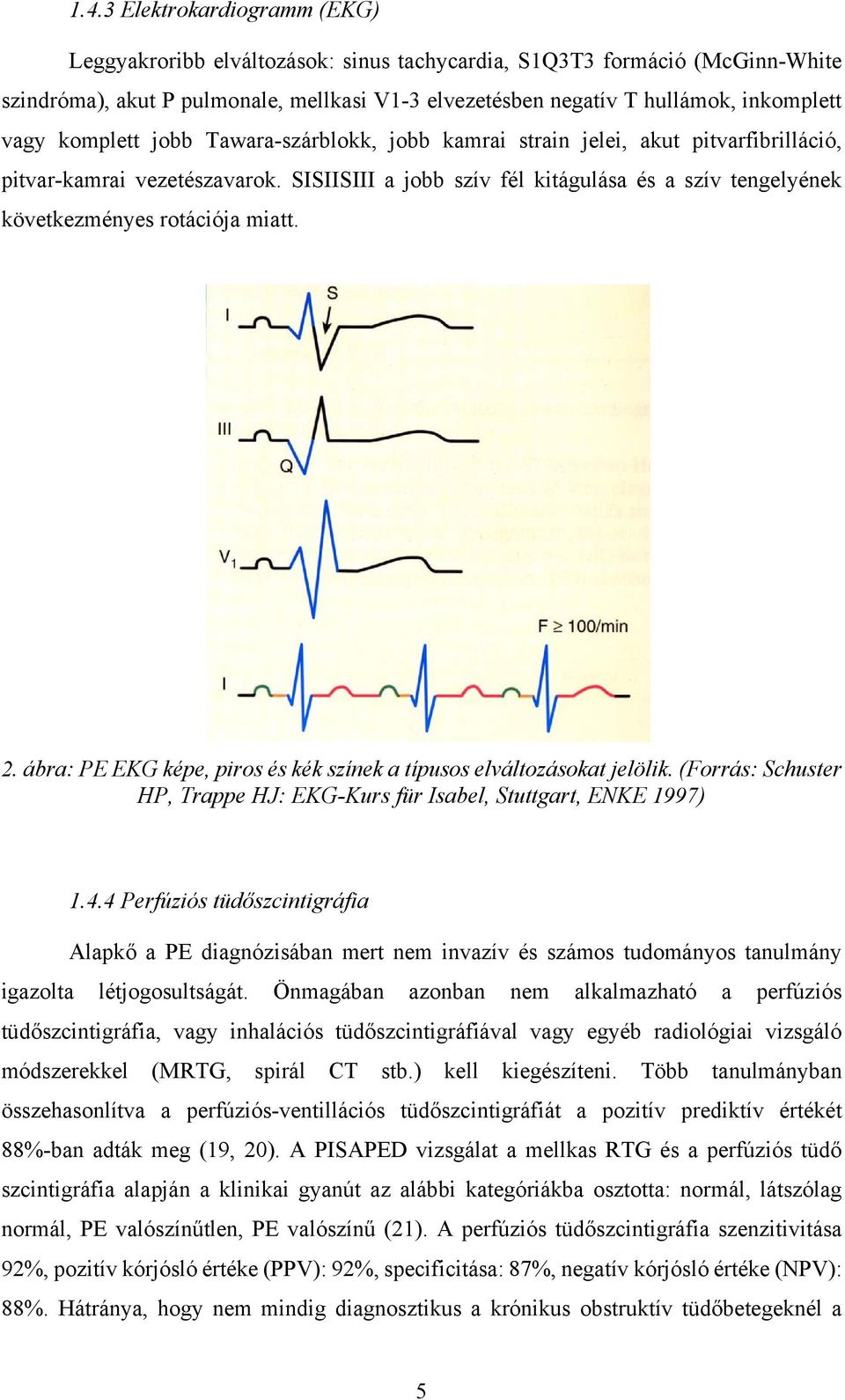 SISIISIII a jobb szív fél kitágulása és a szív tengelyének következményes rotációja miatt. 2. ábra: PE EKG képe, piros és kék színek a típusos elváltozásokat jelölik.