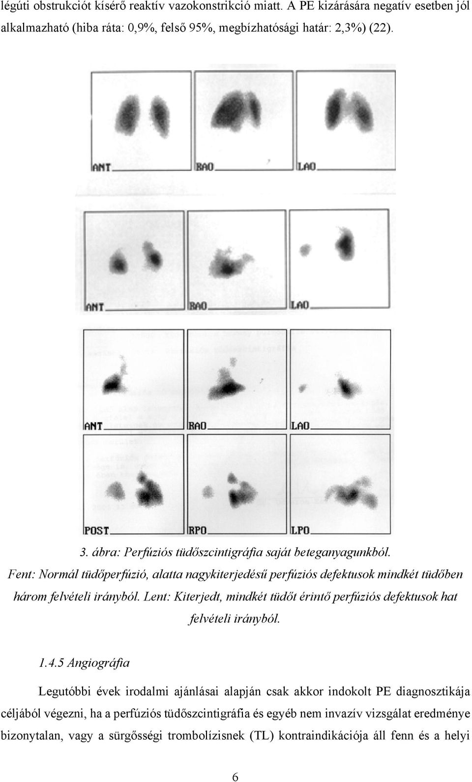 Lent: Kiterjedt, mindkét tüdőt érintő perfúziós defektusok hat felvételi irányból. 1.4.