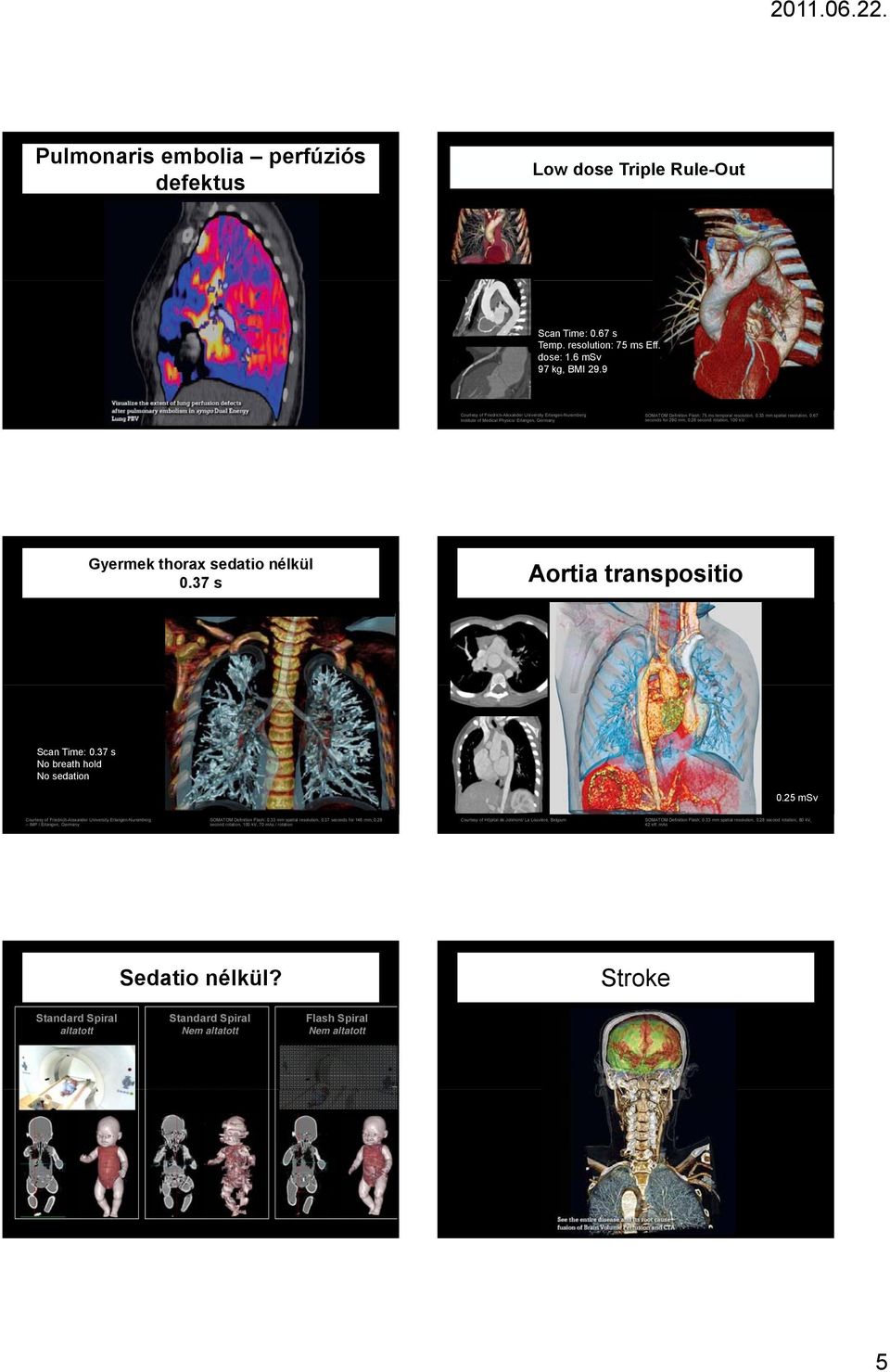 67 seconds for 290 mm, 0.28 second rotation, 100 kv. Gyermek thorax sedatio nélkül 0.37 s Aortia transpositio Scan Time: 0.37 s No breath hold No sedation 0.