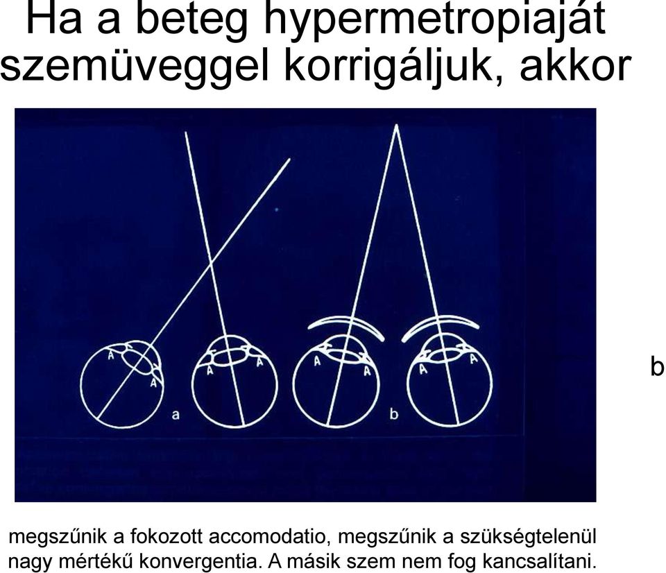 accomodatio, megszűnik a szükségtelenül nagy