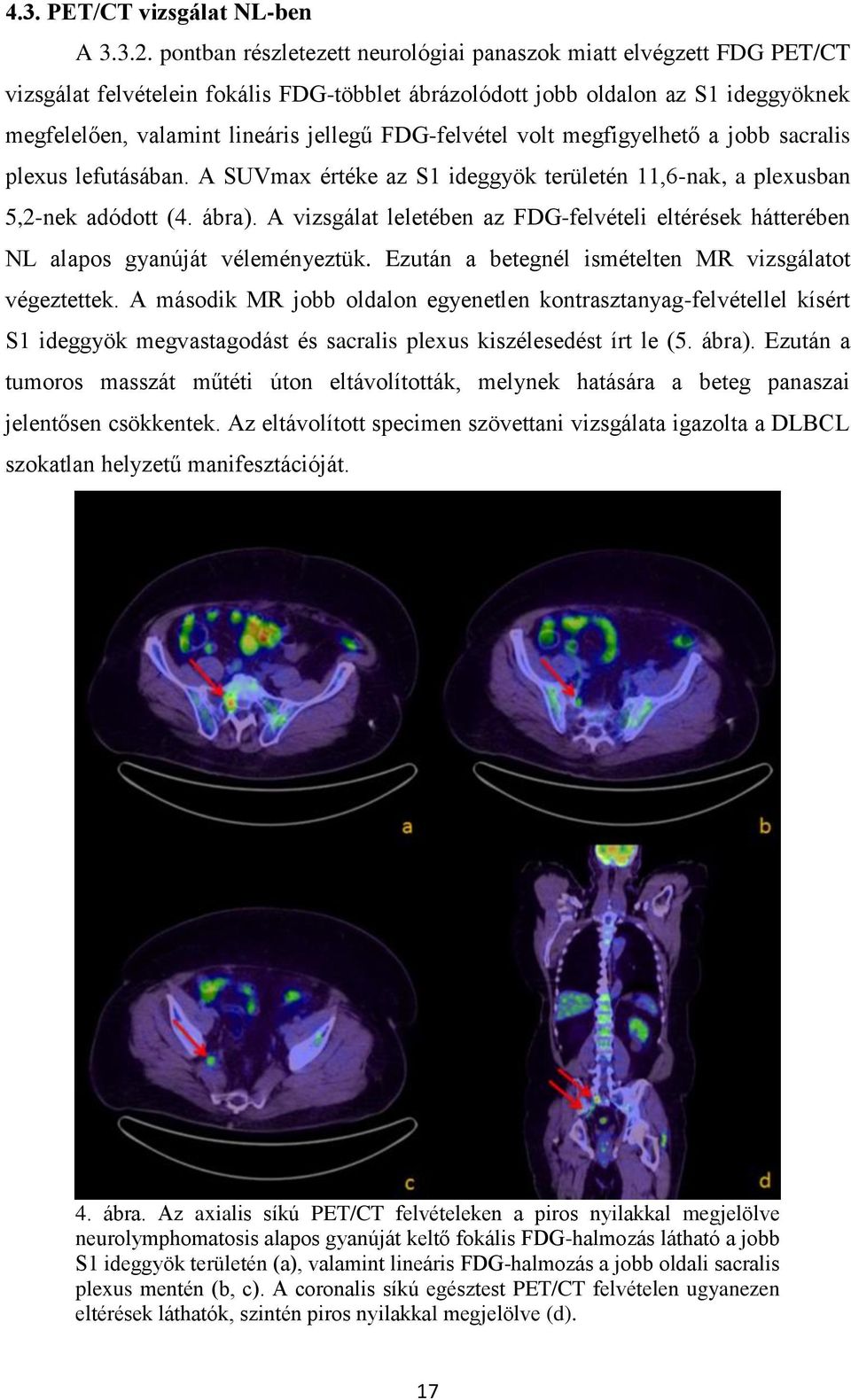 FDG-felvétel volt megfigyelhető a jobb sacralis plexus lefutásában. A SUVmax értéke az S1 ideggyök területén 11,6-nak, a plexusban 5,2-nek adódott (4. ábra).