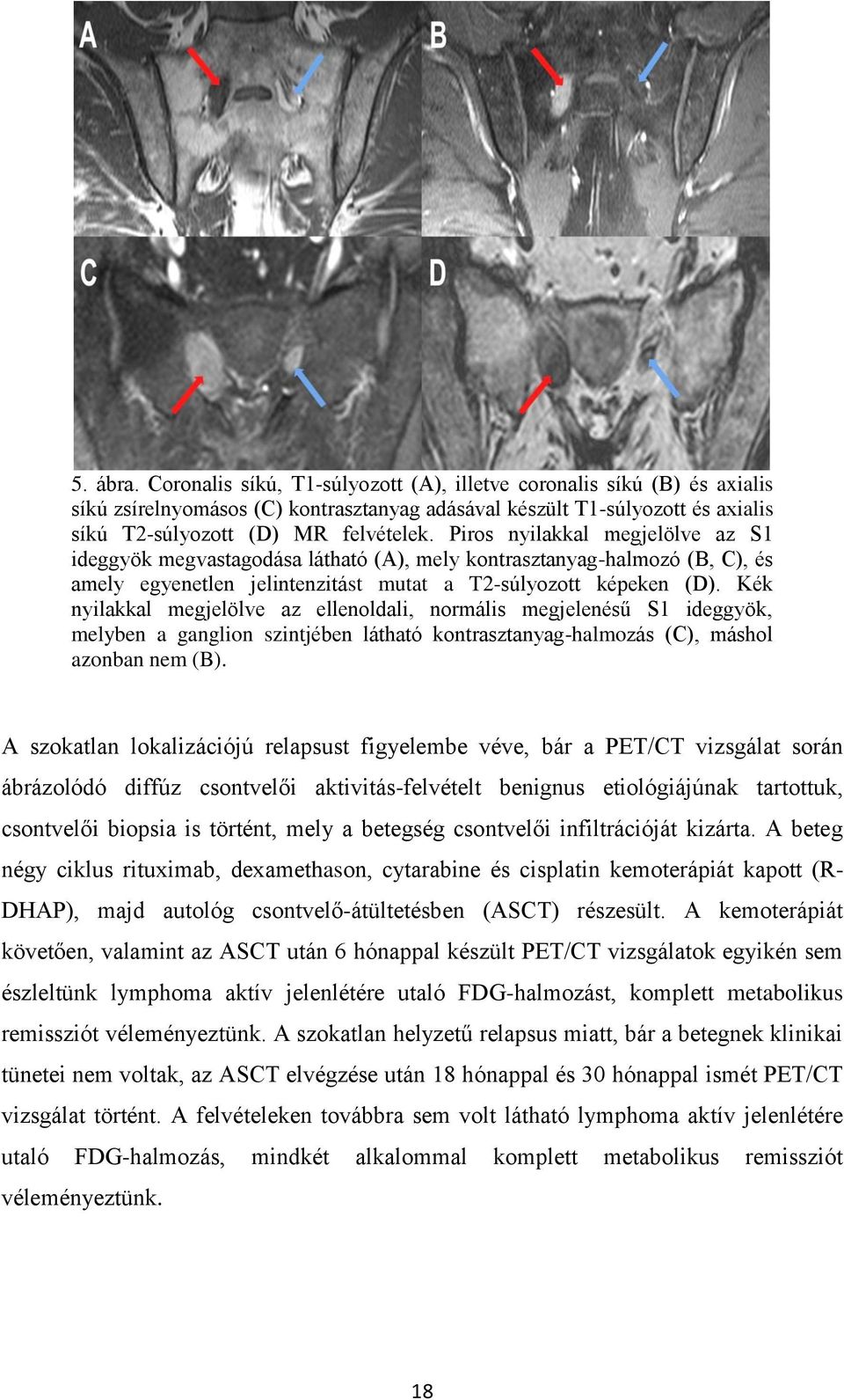 Kék nyilakkal megjelölve az ellenoldali, normális megjelenésű S1 ideggyök, melyben a ganglion szintjében látható kontrasztanyag-halmozás (C), máshol azonban nem (B).