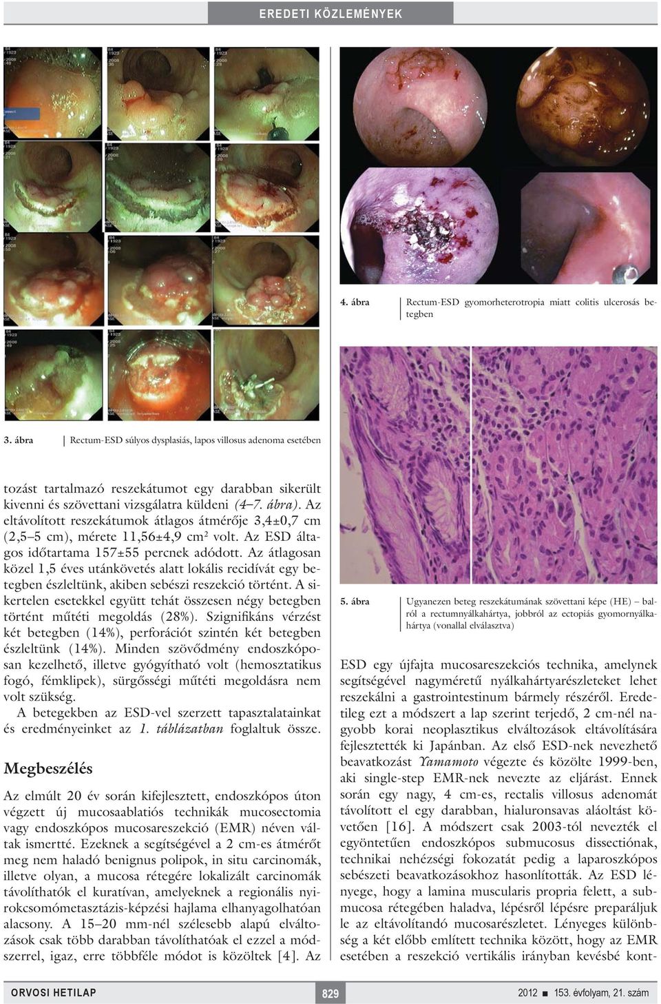 gastrointestinum bármely részéről. Eredetileg ezt a módszert a lap szerint terjedő, 2 cm-nél nagyobb korai neoplasztikus elváltozások eltávolítására fejlesztették ki Japánban.