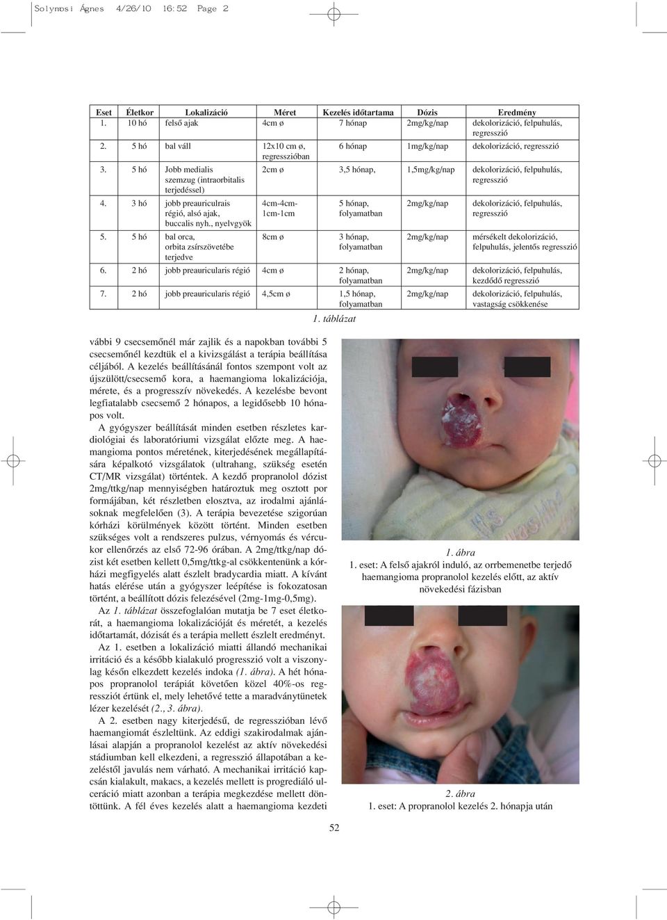 5 hó Jobb medialis 2cm ø 3,5 hónap, 1,5mg/kg/nap dekolorizáció, felpuhulás, szemzug (intraorbitalis regresszió terjedéssel) 4.