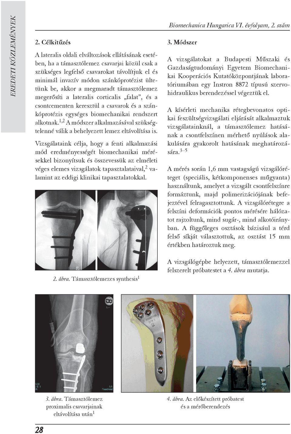 ültetünk be, akkor a megmaradt támasztól emez megerősíti a lateralis corticalis falat, és a csont cementen keresztül a csavarok és a szán - kóprotézis egységes biomechanikai rendszert al kot nak.