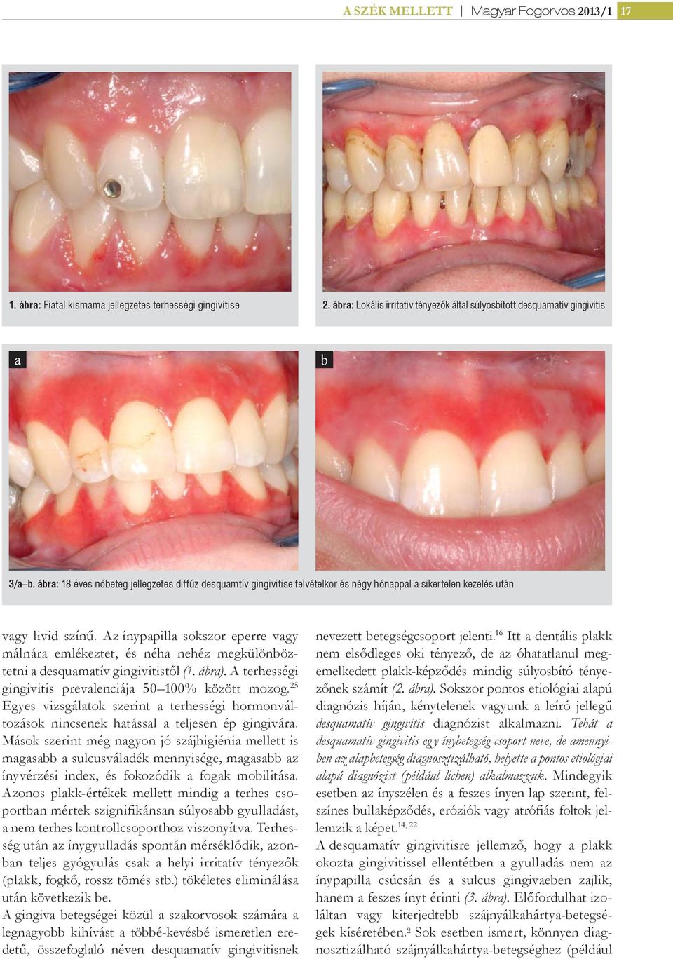 Az ínypapilla sokszor eperre vagy málnára emlékeztet, és néha nehéz megkülönböztetni a desquamatív gingivitistől (1. ábra). A terhességi gingivitis prevalenciája 50 100% között mozog.