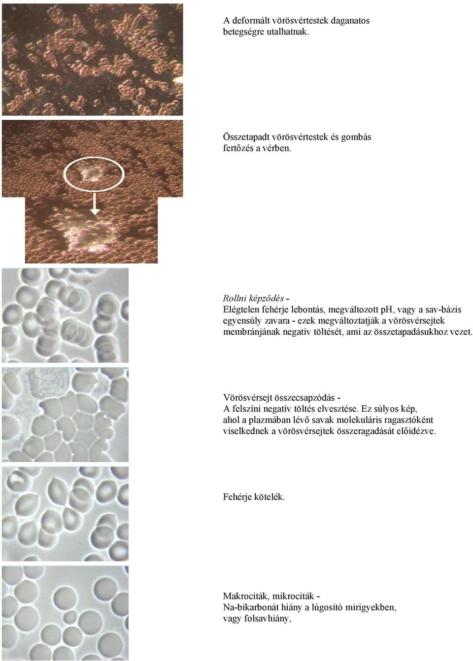 negatív töltését, ami az összetapadásukhoz vezet. Vörösvérsejt összecsapzódás - A felszíni negatív töltés elvesztése.
