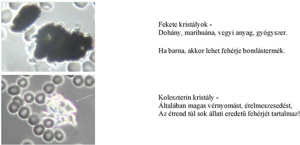 Koleszterin kristály - Általában magas vérnyomást,