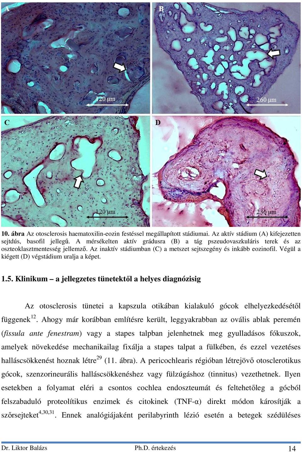 Végül a kiégett (D) végstádium uralja a képet. 1.5. Klinikum a jellegzetes tünetektől a helyes diagnózisig Az otosclerosis tünetei a kapszula otikában kialakuló gócok elhelyezkedésétől függenek 12.