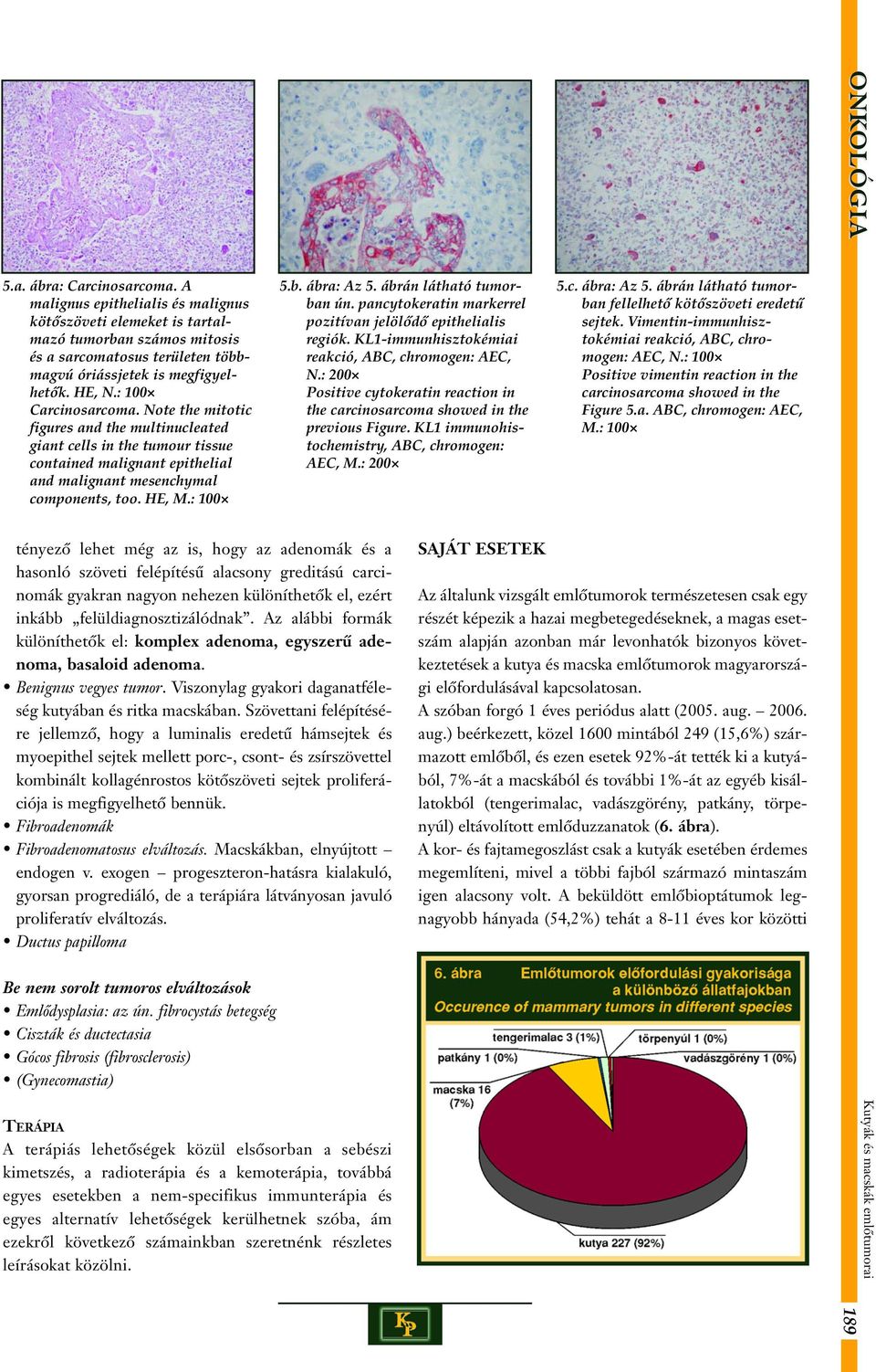 ábra: Az 5. ábrán látható tumorban ún. pancytokeratin markerrel pozitívan jelölôdô epithelialis regiók. KL1-immunhisztokémiai reakció, ABC, chromogen: AEC, N.