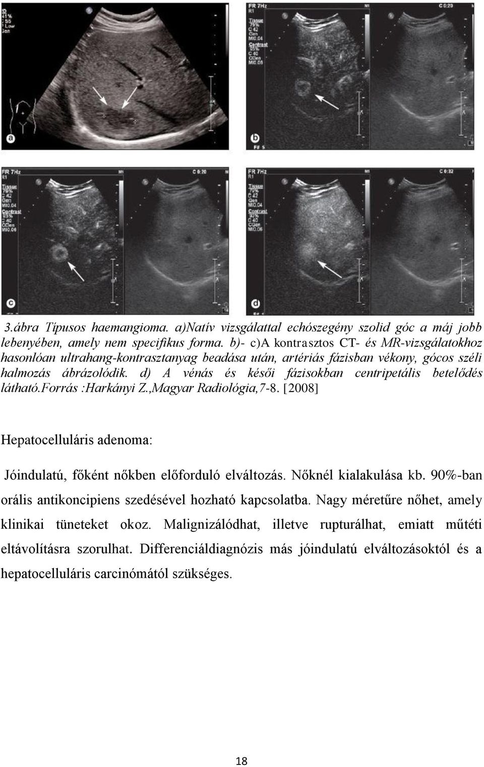 d) A vénás és késői fázisokban centripetális betelődés látható.forrás :Harkányi Z.,Magyar Radiológia,7-8. [2008] Hepatocelluláris adenoma: Jóindulatú, főként nőkben előforduló elváltozás.