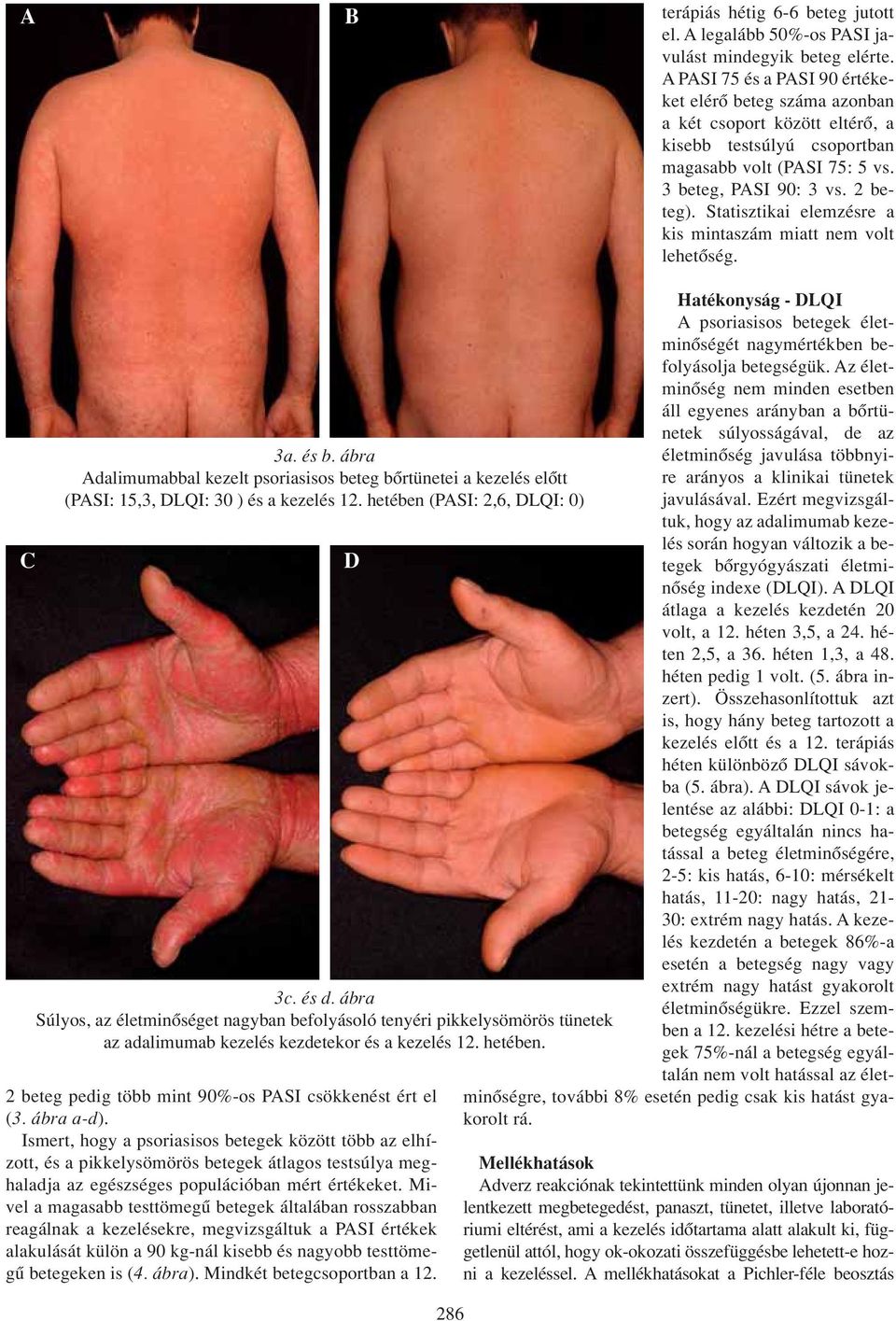 Statisztikai elemzésre a kis mintaszám miatt nem volt lehetôség. C 3a. és b. ábra Adalimumabbal kezelt psoriasisos beteg bôrtünetei a kezelés elôtt (PASI: 15,3, DLQI: 30 ) és a kezelés 12.