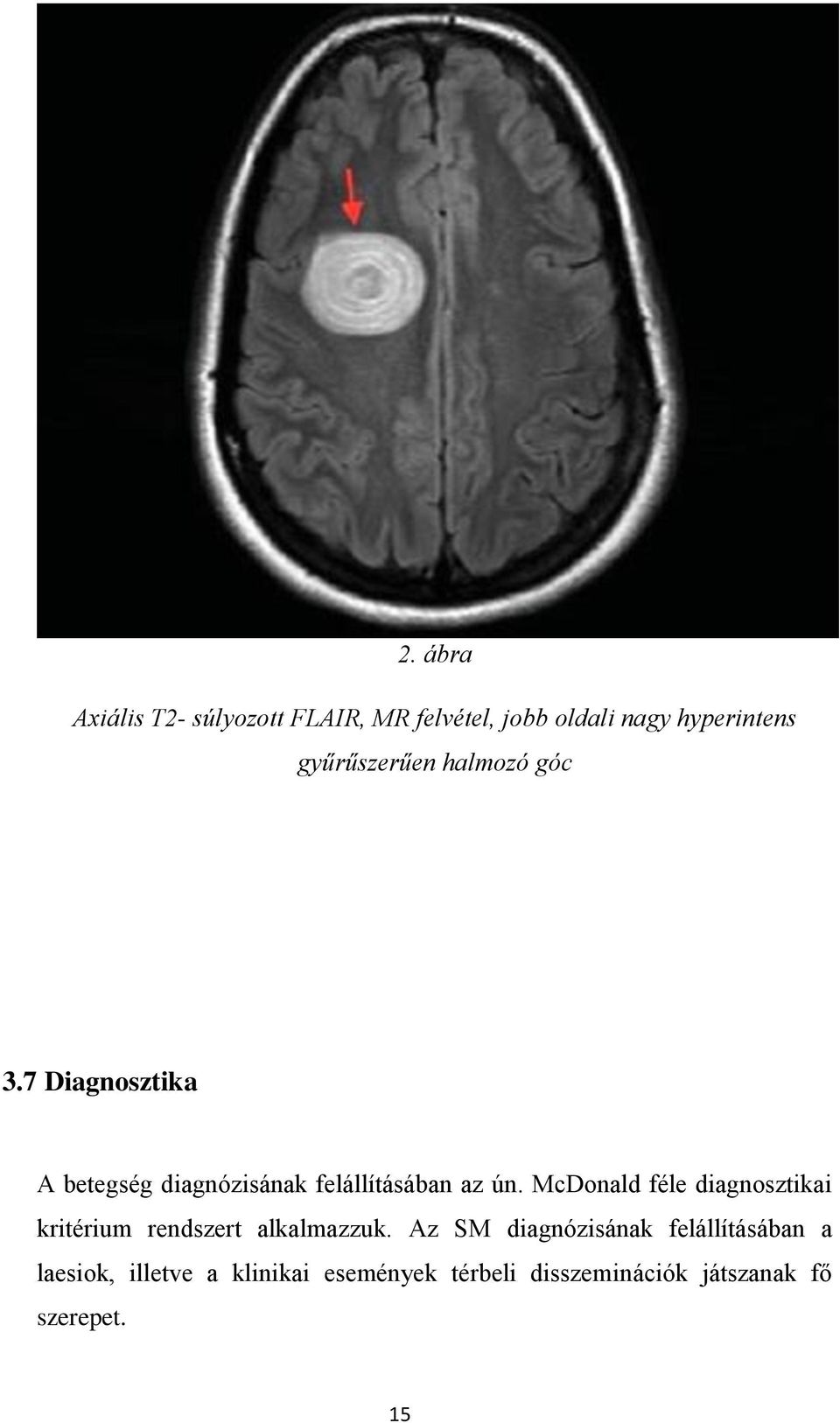 McDonald féle diagnosztikai kritérium rendszert alkalmazzuk.
