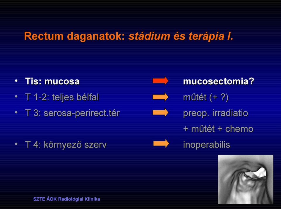 T 1-2: teljes bélfal műtét (+?