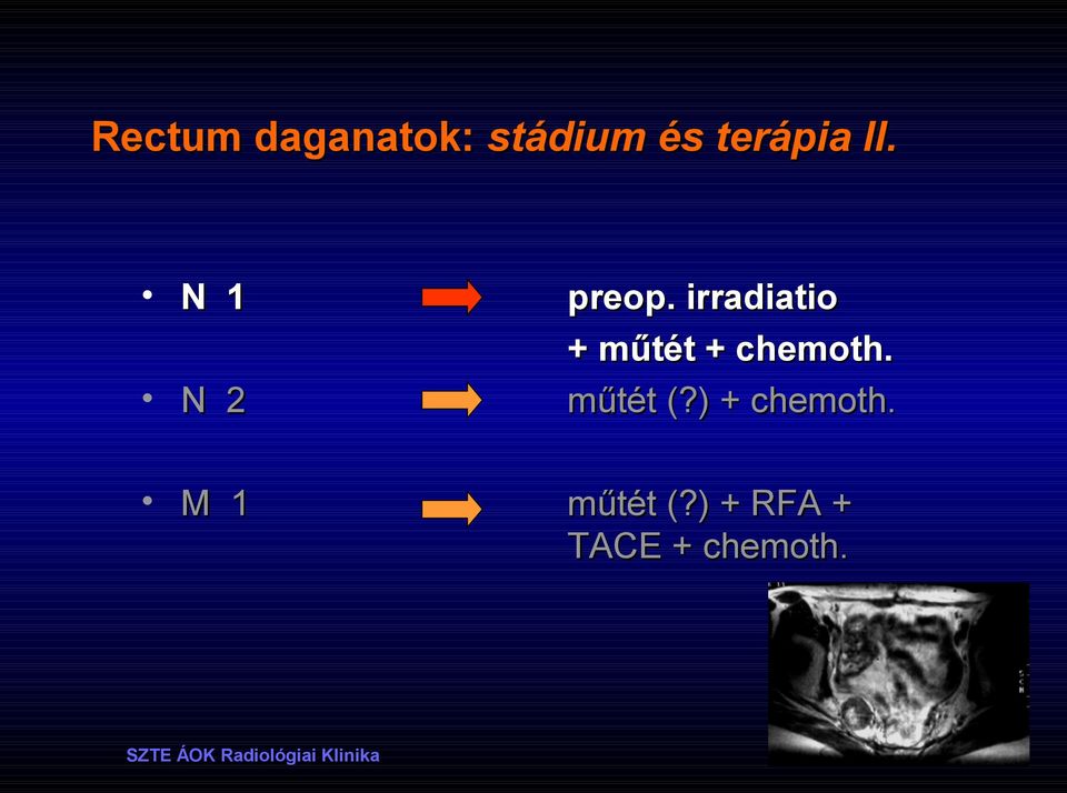 irradiatio + műtét + chemoth.