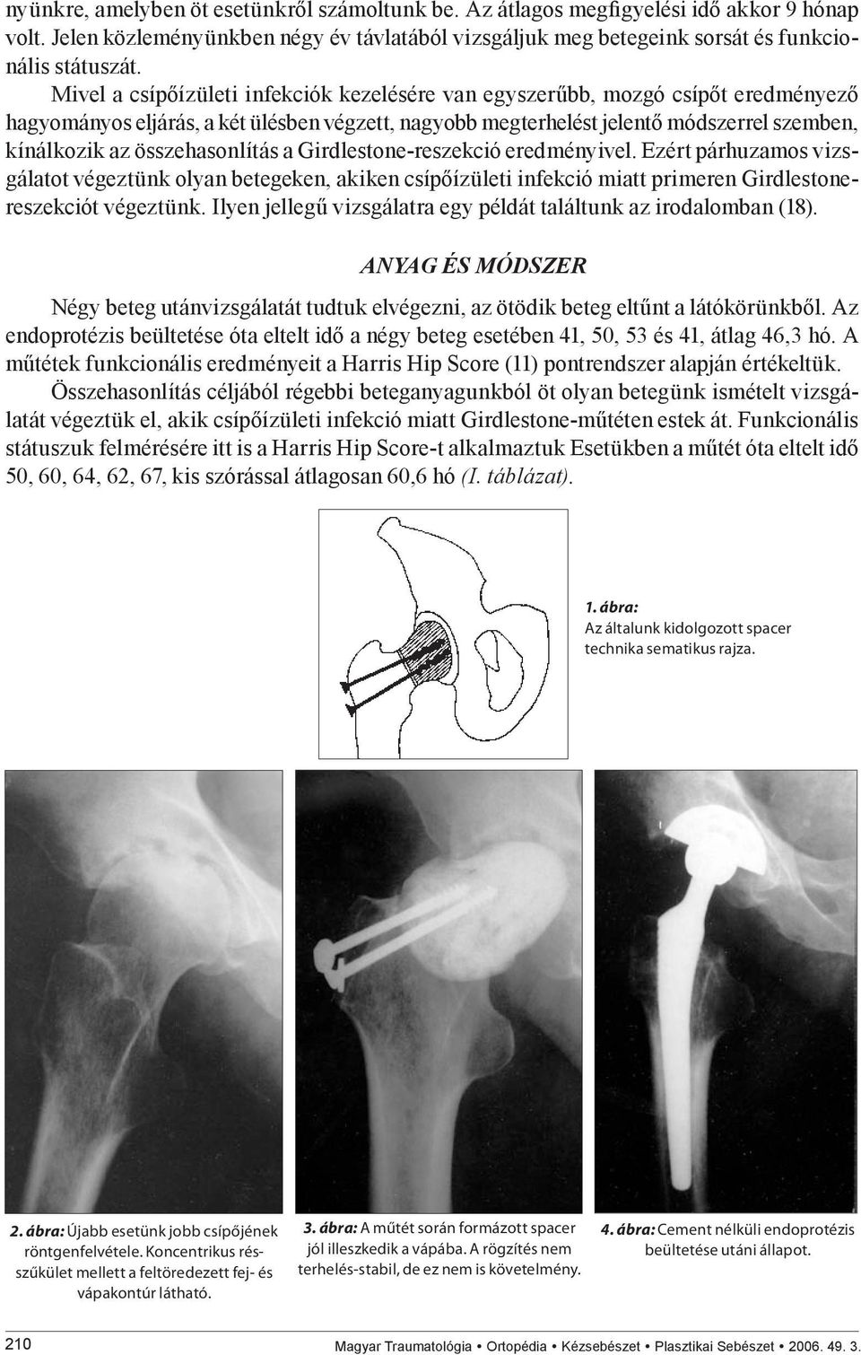 összehasonlítás a Girdlestone-reszekció eredményivel. Ezért párhuzamos vizsgálatot végeztünk olyan betegeken, akiken csípőízületi infekció miatt primeren Girdlestonereszekciót végeztünk.
