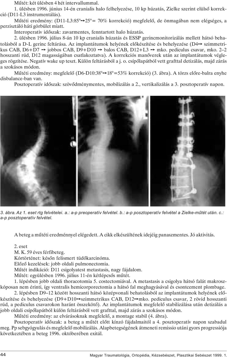 július 8-án 10 kp cranialis húzatás és ESSP gerincmonitorizálás mellett hátsó behatolásból a D-L gerinc feltárása.