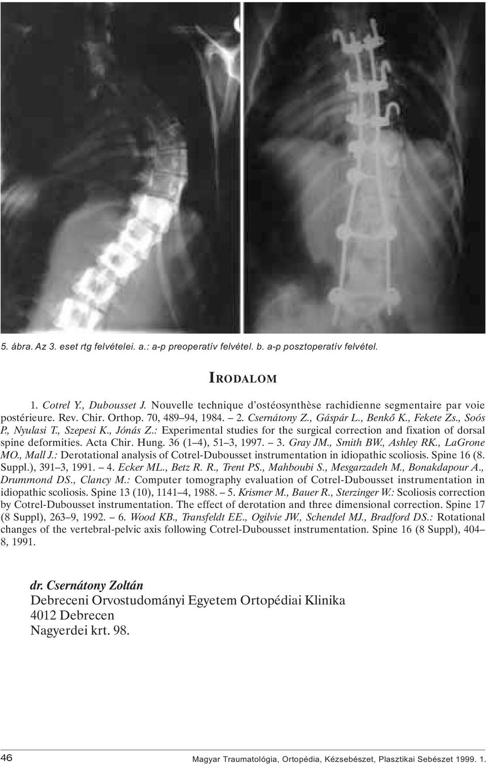 , Jónás Z.: Experimental studies for the surgical correction and fixation of dorsal spine deformities. Acta Chir. Hung. 36 (1 4), 51 3, 1997. 3. Gray JM., Smith BW., Ashley RK., LaGrone MO., Mall J.