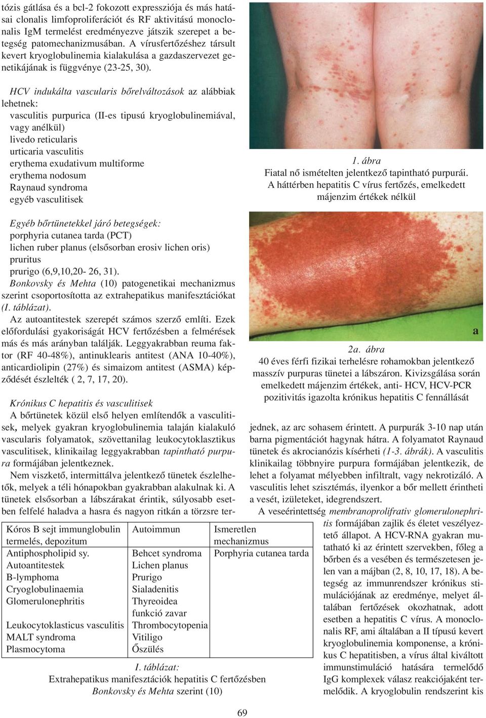 HCV indukálta vascularis bôrelváltozások az alábbiak lehetnek: vasculitis purpurica (II-es tipusú kryoglobulinemiával, vagy anélkül) livedo reticularis urticaria vasculitis erythema exudativum