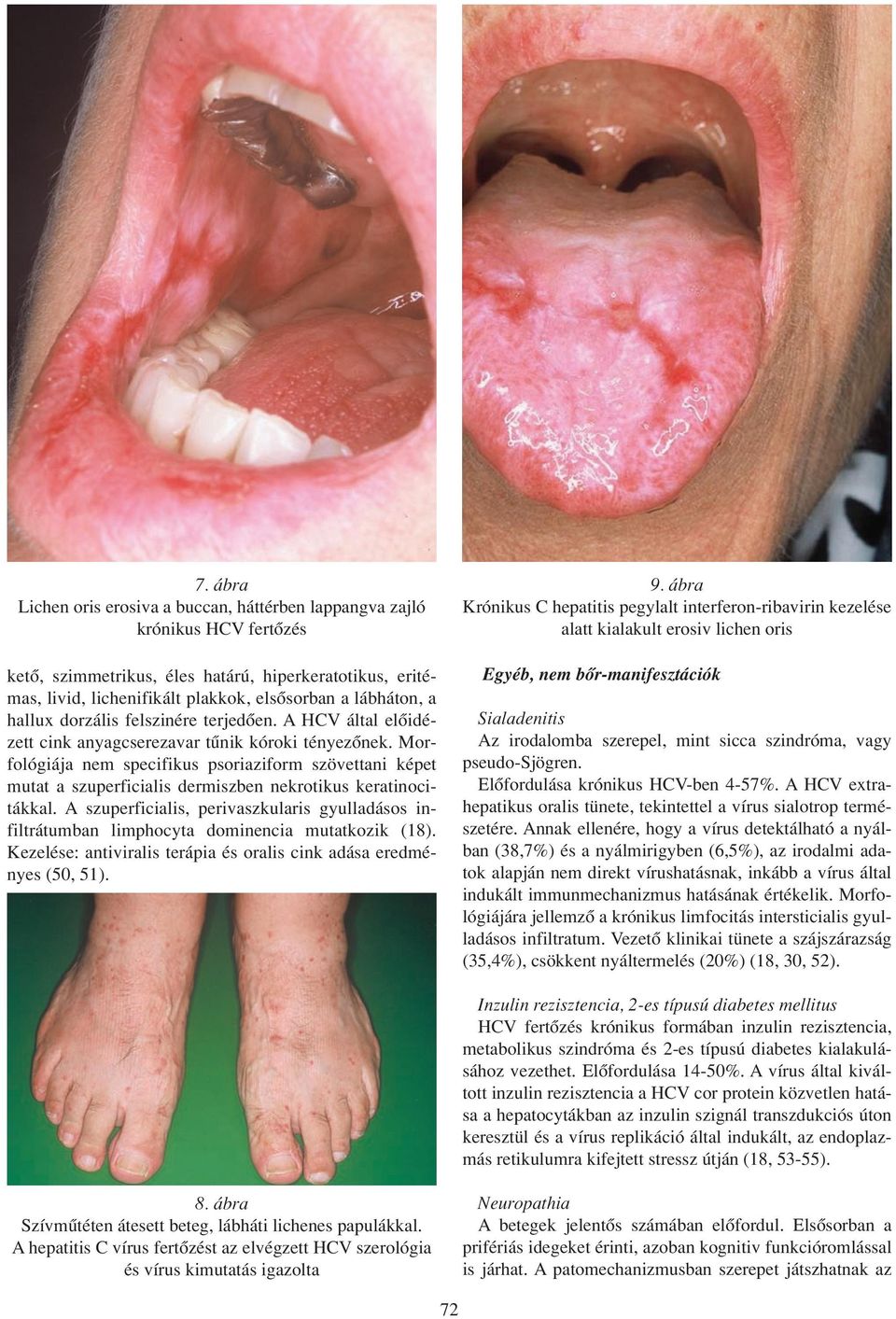 Morfológiája nem specifikus psoriaziform szövettani képet mutat a szuperficialis dermiszben nekrotikus keratinocitákkal.