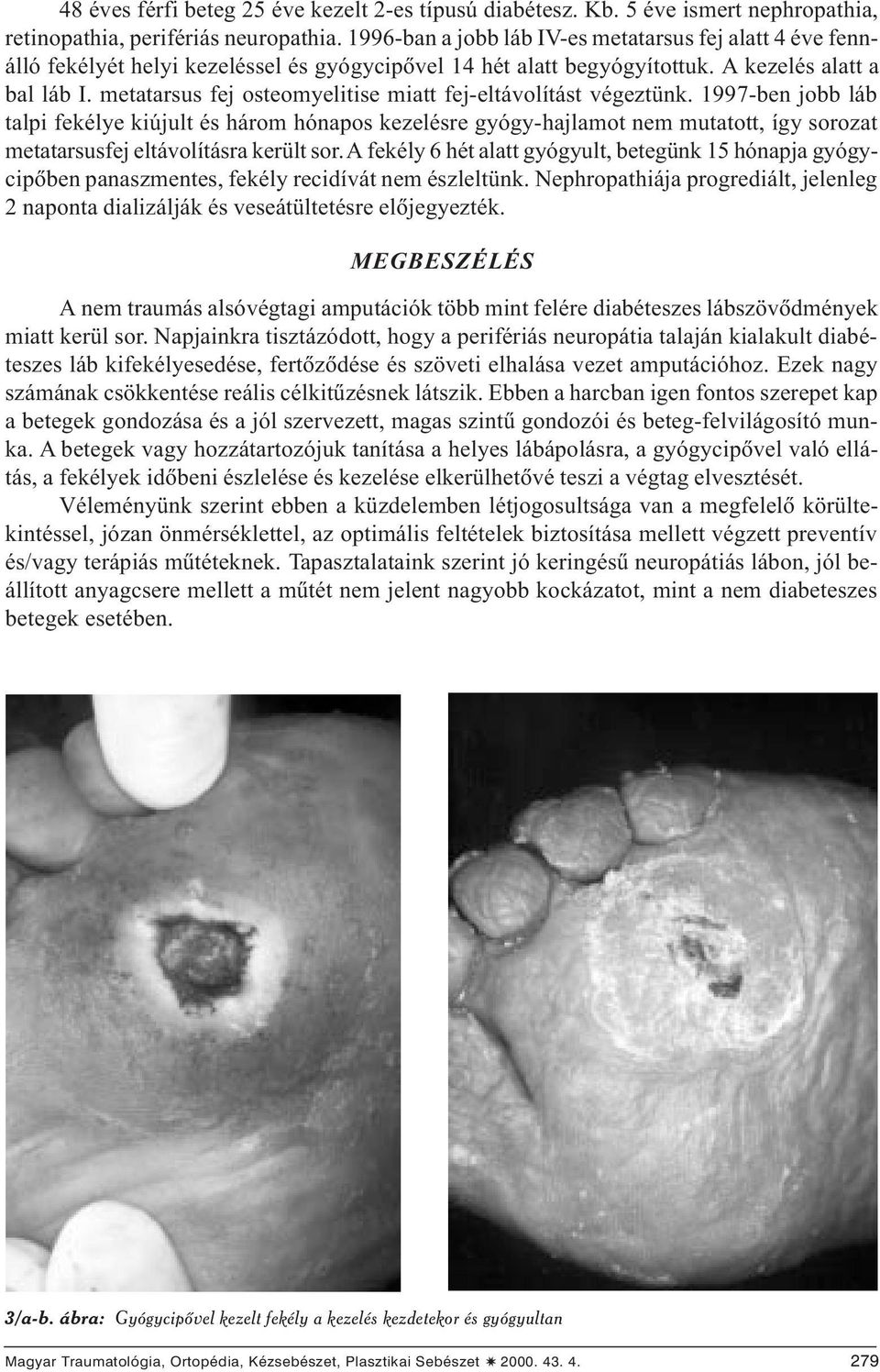 metatarsus fej osteomyelitise miatt fej-eltávolítást végeztünk.