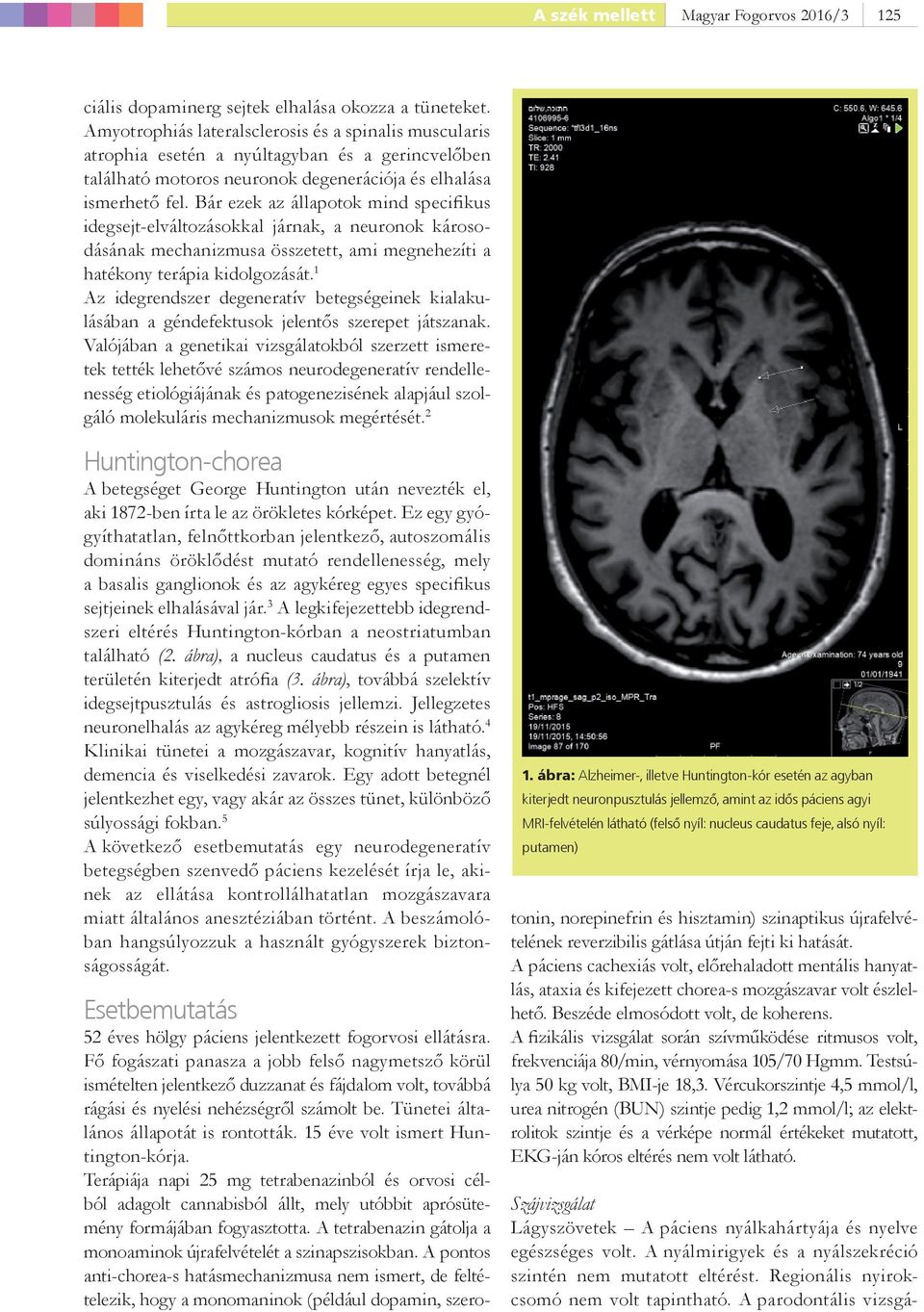 Bár ezek az állapotok mind specifikus idegsejt-elváltozásokkal járnak, a neuronok károsodásának mechanizmusa összetett, ami megnehezíti a hatékony terápia kidolgozását.