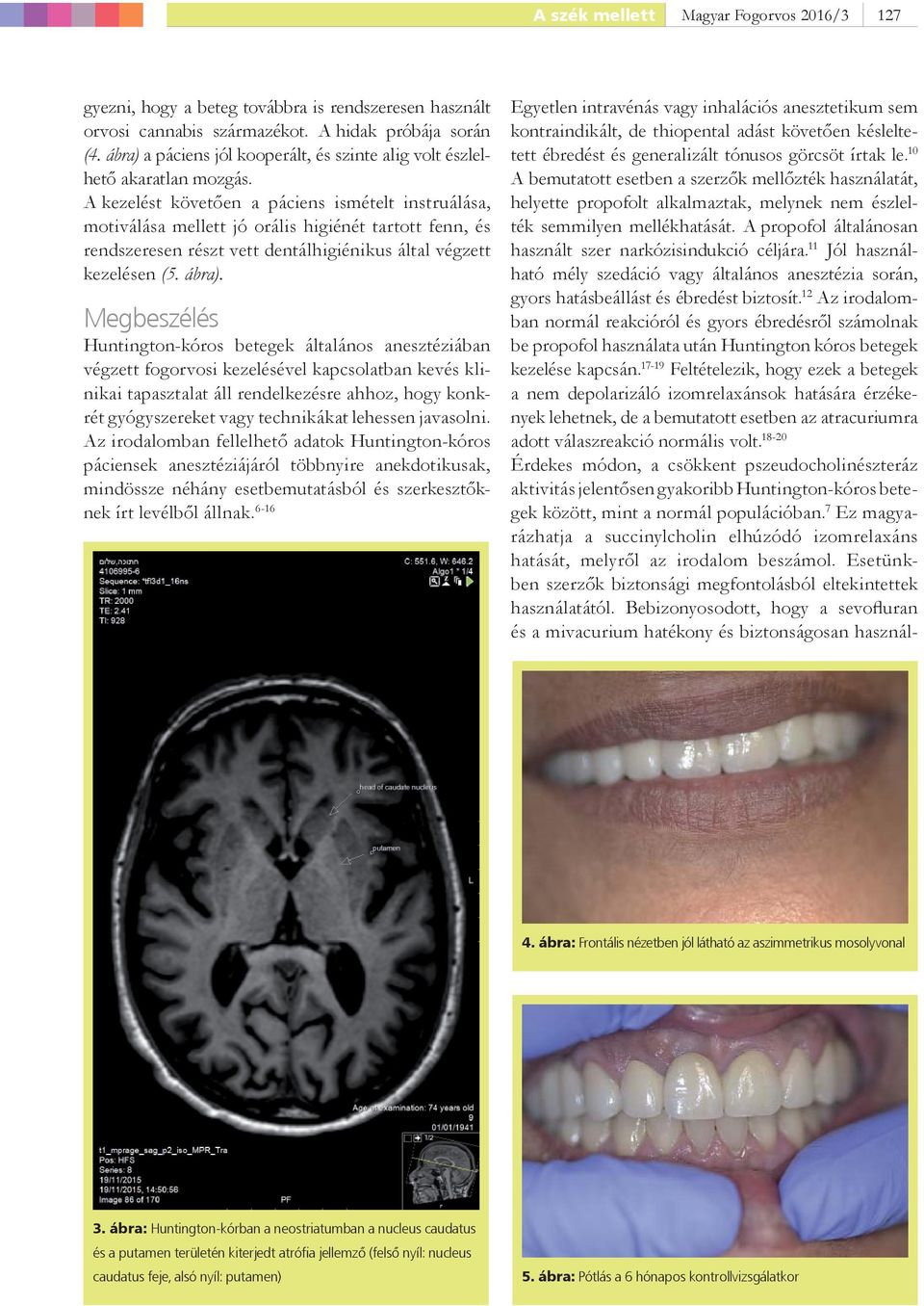 A kezelést követően a páciens ismételt instruálása, motiválása mellett jó orális higiénét tartott fenn, és rendszeresen részt vett dentálhigiénikus által végzett kezelésen (5. ábra).