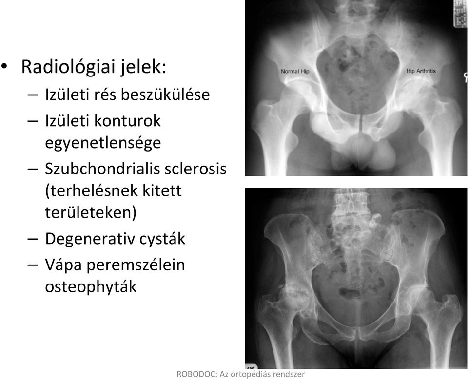 Szubchondrialis sclerosis (terhelésnek kitett