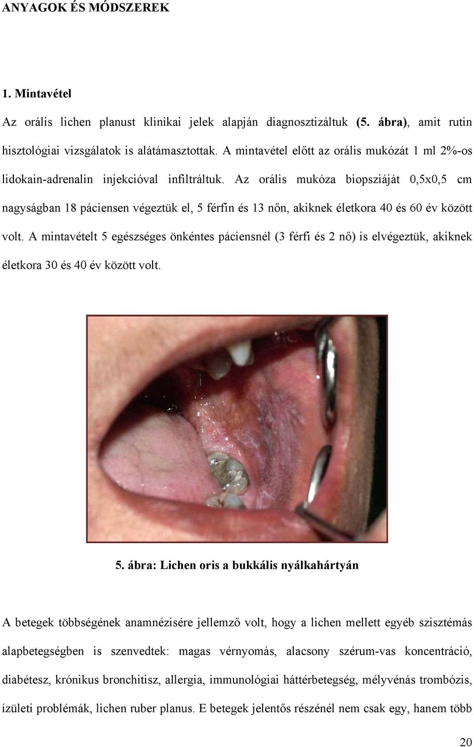 Az orális mukóza biopsziáját 0,5x0,5 cm nagyságban 18 páciensen végeztük el, 5 férfin és 13 nőn, akiknek életkora 40 és 60 év között volt.