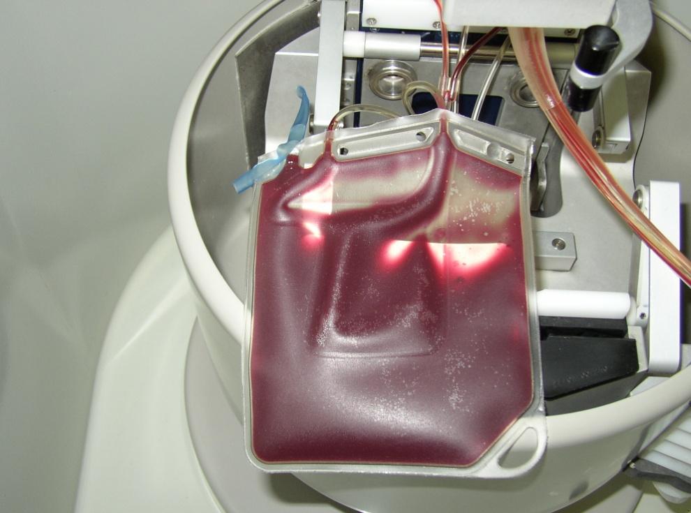 Őssejtgyűjtés apheresis technikával