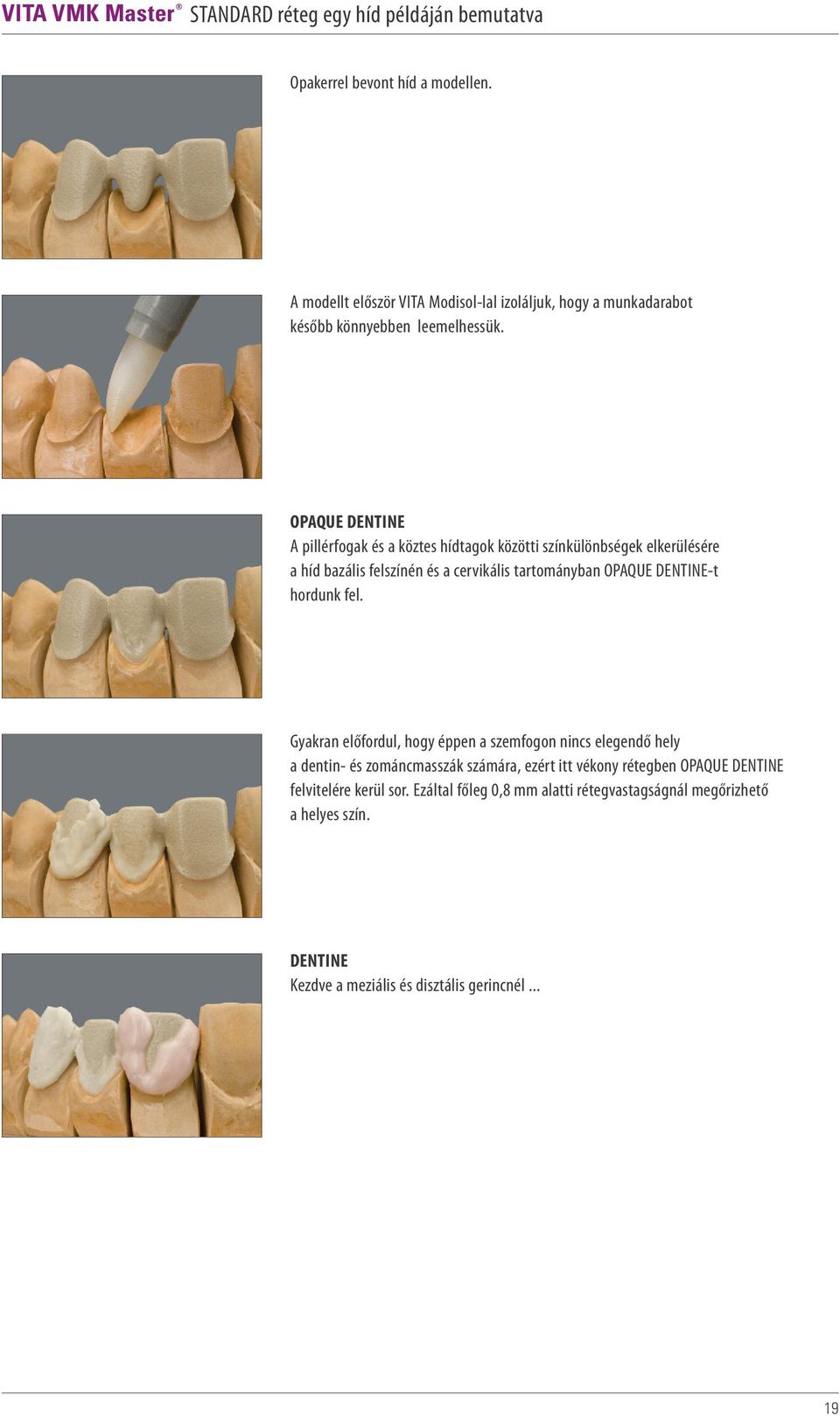 OPAQUE DENTINE A pillérfogak és a köztes hídtagok közötti színkülönbségek elkerülésére a híd bazális felszínén és a cervikális tartományban OPAQUE DENTINE-t