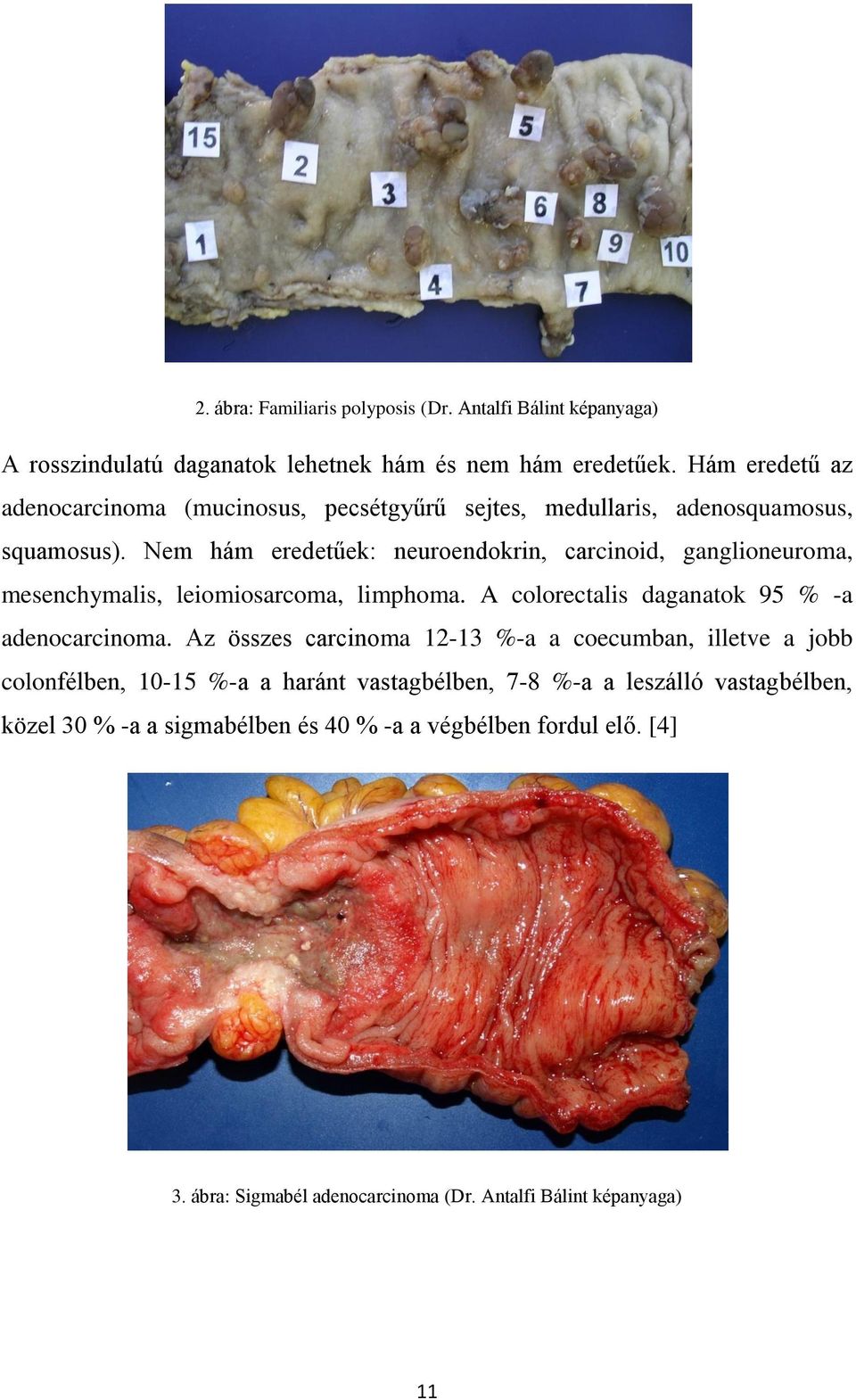 Nem hám eredetűek: neuroendokrin, carcinoid, ganglioneuroma, mesenchymalis, leiomiosarcoma, limphoma. A colorectalis daganatok 95 % -a adenocarcinoma.