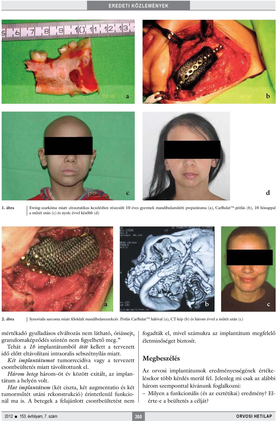 ábra Synovialis sarcoma miatt féloldali mandibulareszekció.