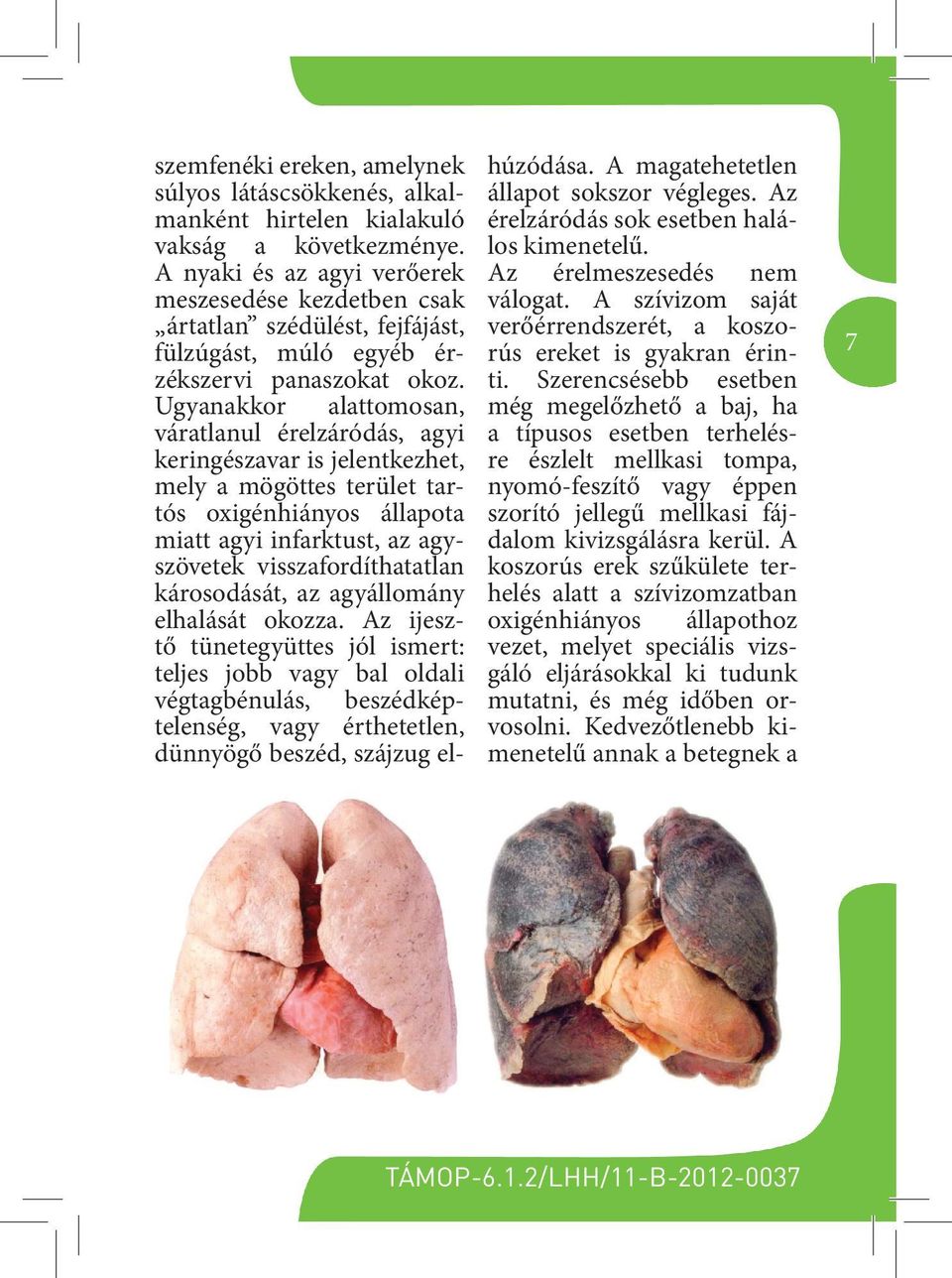 Ugyanakkor alattomosan, váratlanul érelzáródás, agyi keringészavar is jelentkezhet, mely a mögöttes terület tartós oxigénhiányos állapota miatt agyi infarktust, az agyszövetek visszafordíthatatlan