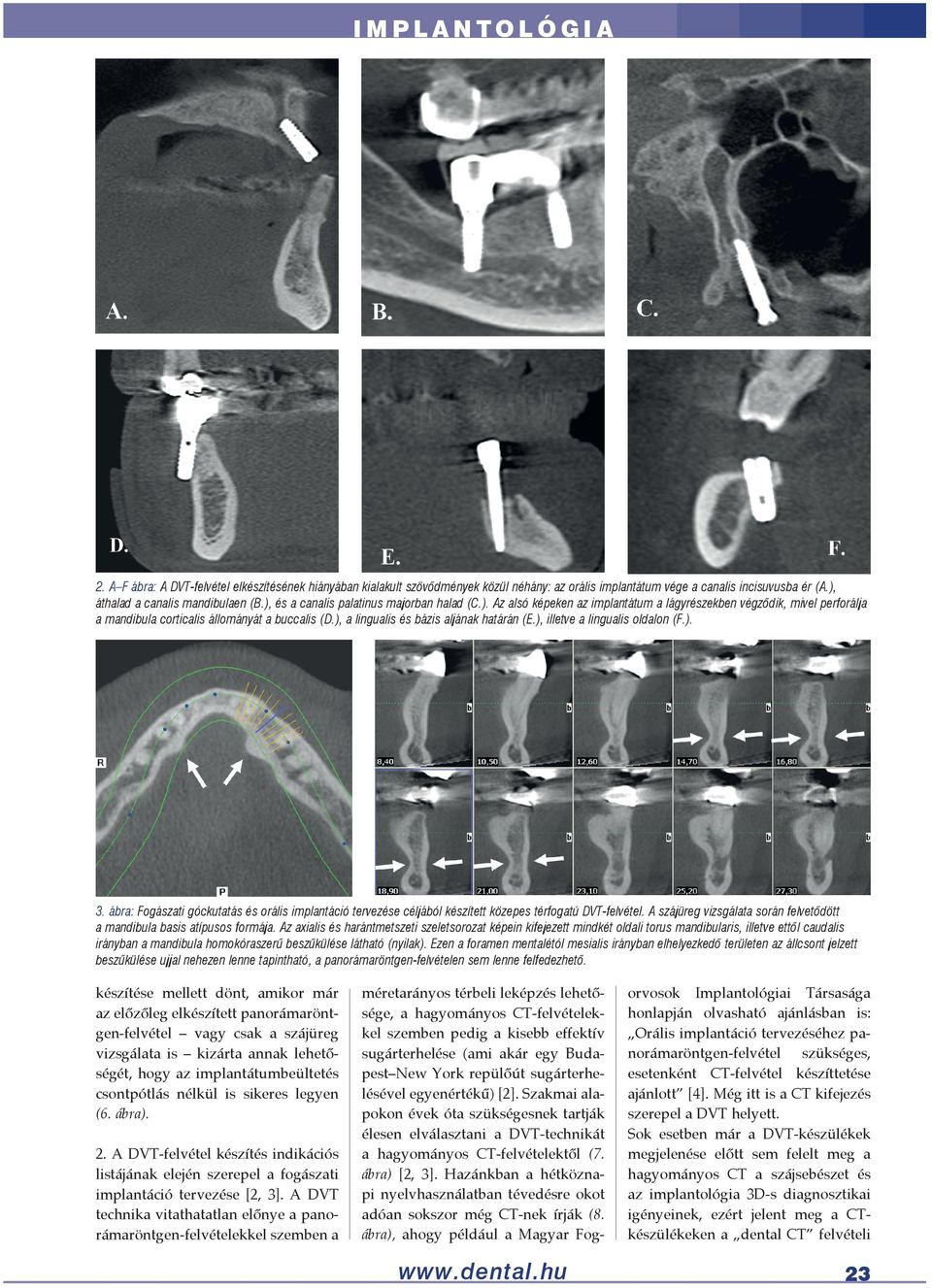 ), a lingualis és bázis aljának határán (E.), illetve a lingualis oldalon (F.). 3. ábra: Fogászati góckutatás és orális implantáció tervezése céljából készített közepes térfogatú DVT-felvétel.