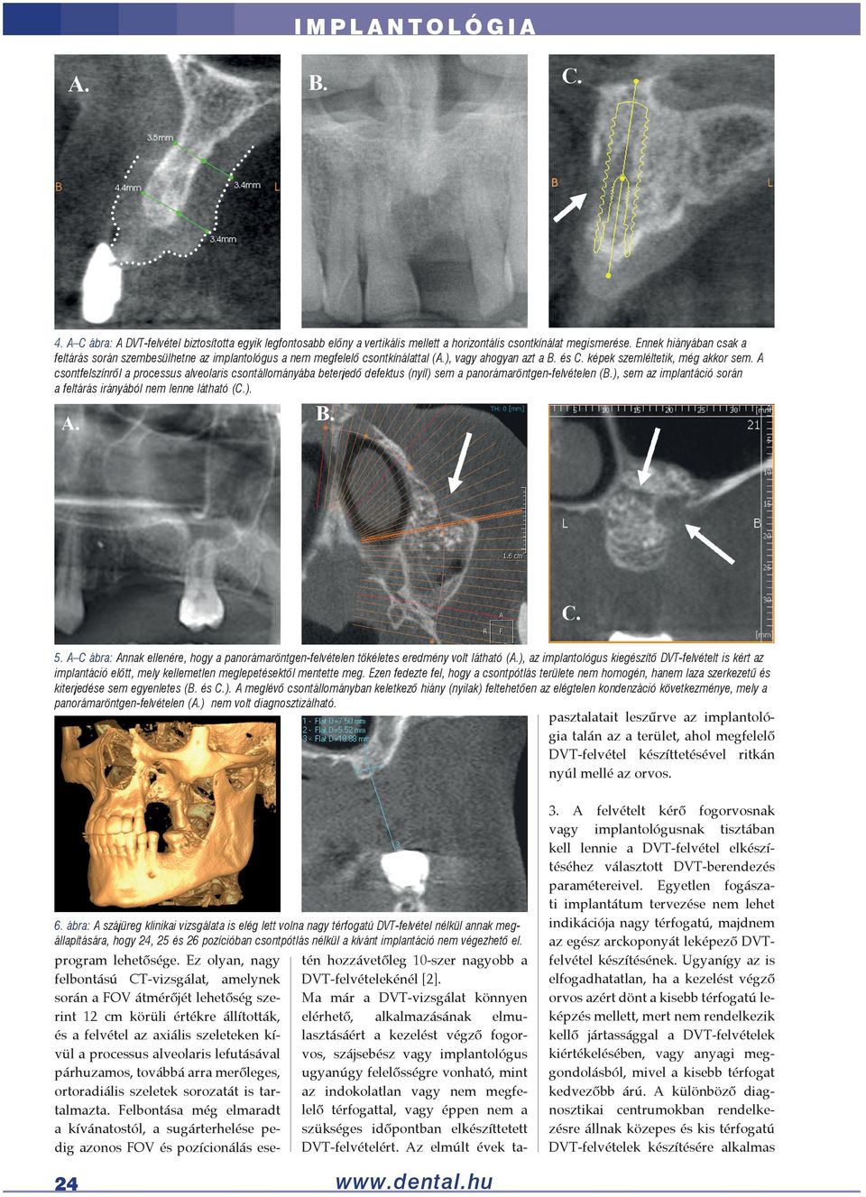 A csontfelszínről a processus alveolaris csontállományába beterjedő defektus (nyíl) sem a panorámaröntgen-felvételen (B.), sem az implantáció során a feltárás irányából nem lenne látható (C.). 5.