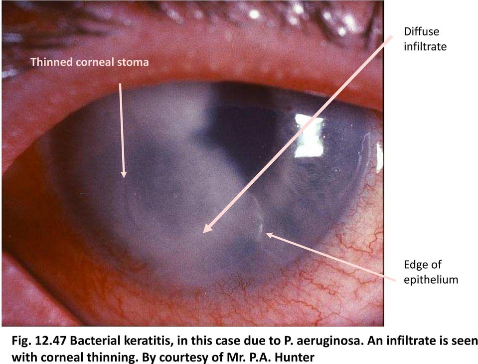47 Bacterial keratitis, in this case due to P.