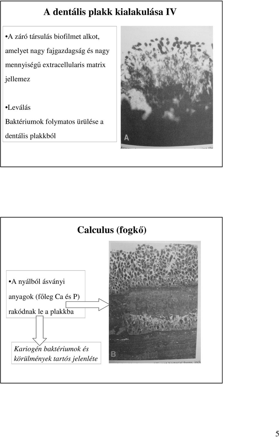 folymatos ürülése a dentális plakkból Calculus (fogkı) A nyálból ásványi anyagok