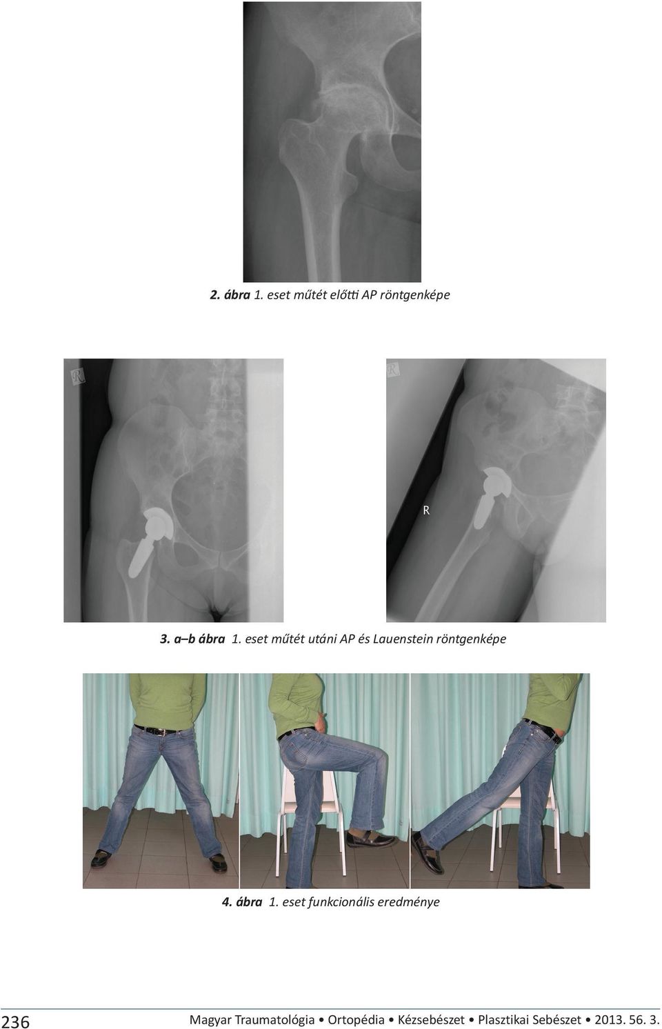 eset műtét utáni AP és Lauenstein röntgenképe 4. ábra 1.