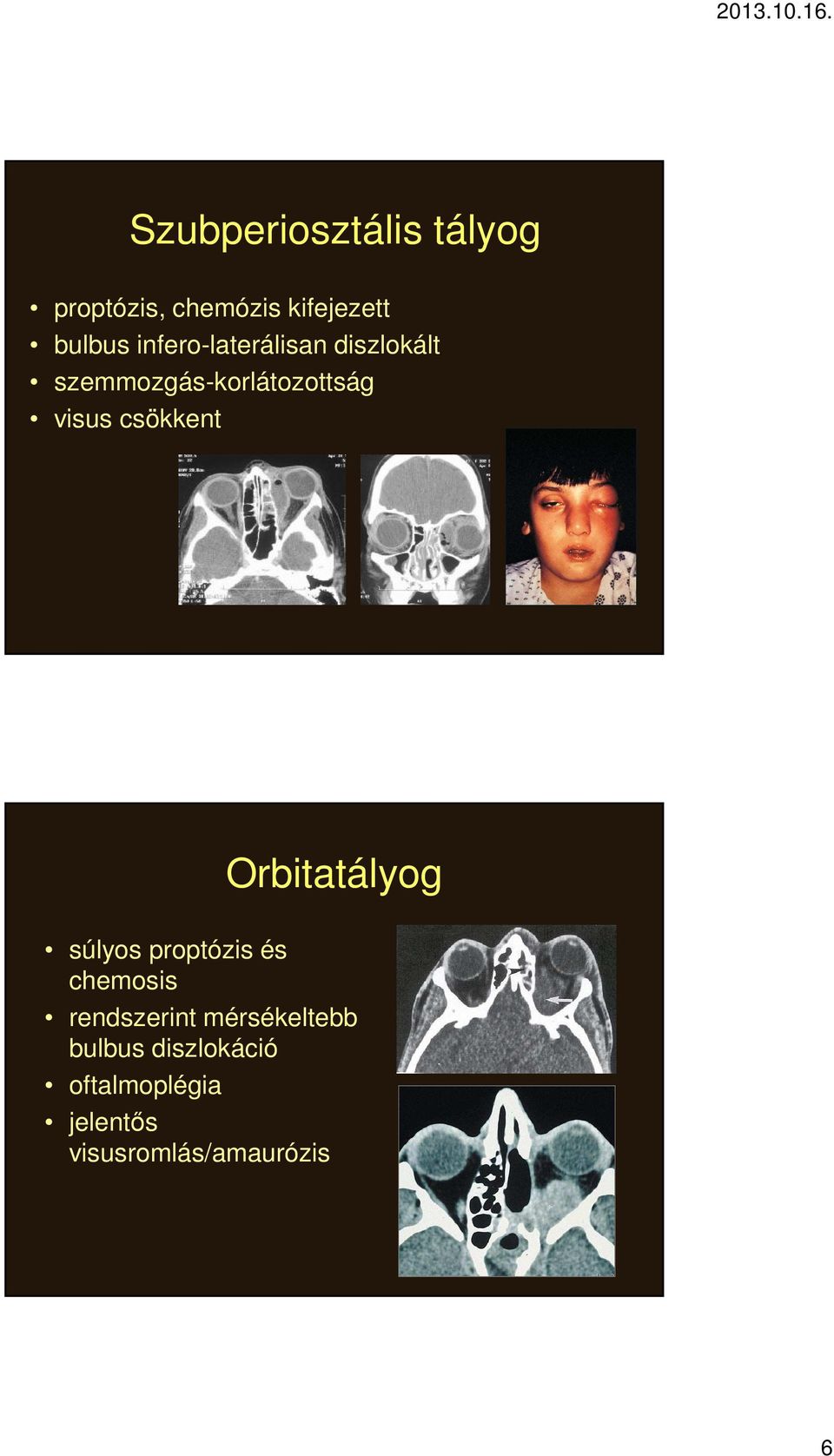 csökkent Orbitatályog súlyos proptózis és chemosis rendszerint