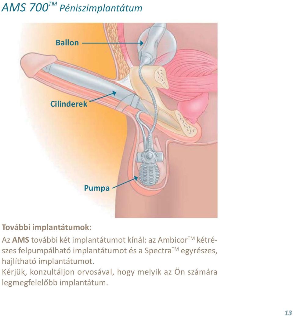 implantátumot és a Spectra TM egy ré szes, hajlítható implantátumot.