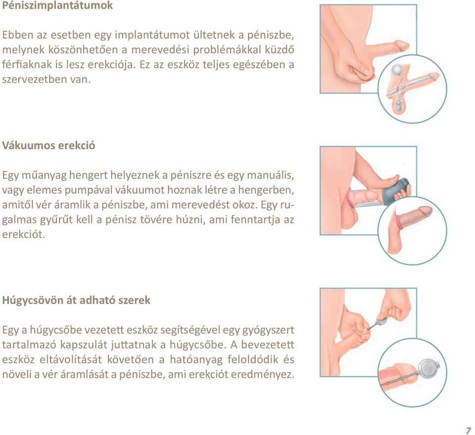 Vákuumos erekció Egy műanyag hengert helyeznek a péniszre és egy manuális, vagy elemes pumpával vákuumot hoznak létre a hengerben, amitől vér áramlik a péniszbe, ami merevedést okoz.