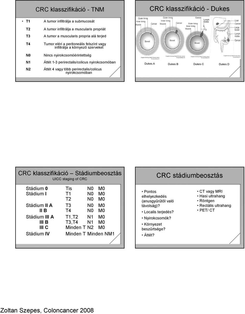 Dukes B Dukes C Dukes D CRC klasszifikáció Stádiumbeosztás UICC staging of CRC CRC stádiumbeosztás Stádium 0 Tis N0 M0 Stádium I T1 N0 M0 T2 N0 M0 Stádium II A T3 N0 M0 II B T4 N0 M0 Stádium III A