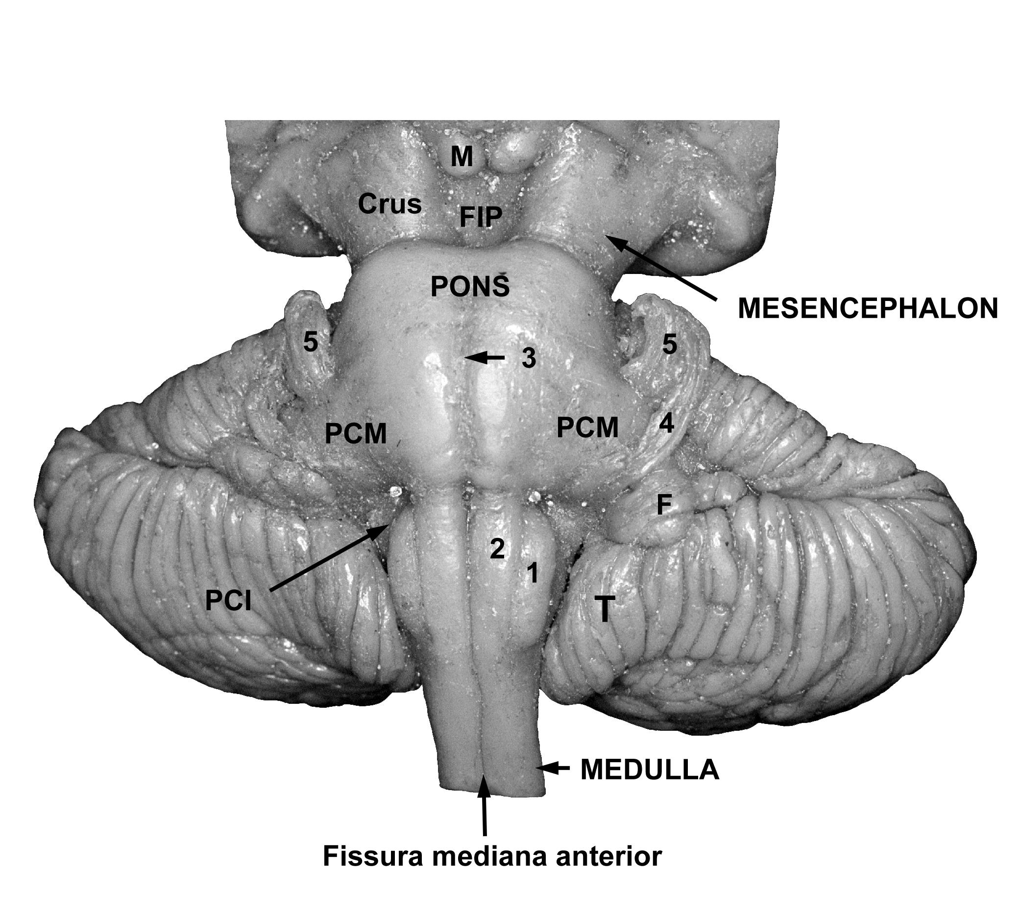 KÖZÉPSŐ- ÉS ALSÓ KISAGYKAROK (PCM, PCI) FIP: fossa interpeduncularis PCI: pedunculus cerebellaris inferior PCM: pedunculus